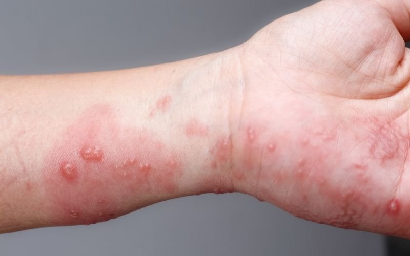 Latex Allergy Symptoms & Causes: What to Know in 2025