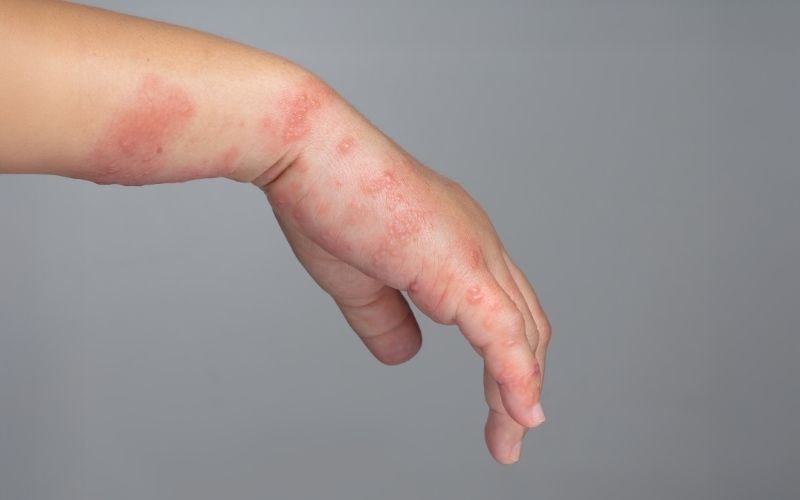 Latex Allergy Symptoms When Everyday Contact Triggers an Immune Reaction